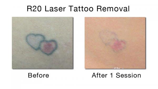 ... Price Red&amp;Green Ruby Laser Tattoo Removal Machine of ec91148778