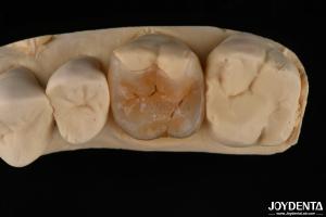 Wholesale Custom Compound Inlay Onlay For Minimally Invasive Dental Restoration from china suppliers