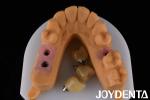 Porcelain Implant Crown and Bridge The Ultimate Solution for Restoration Of