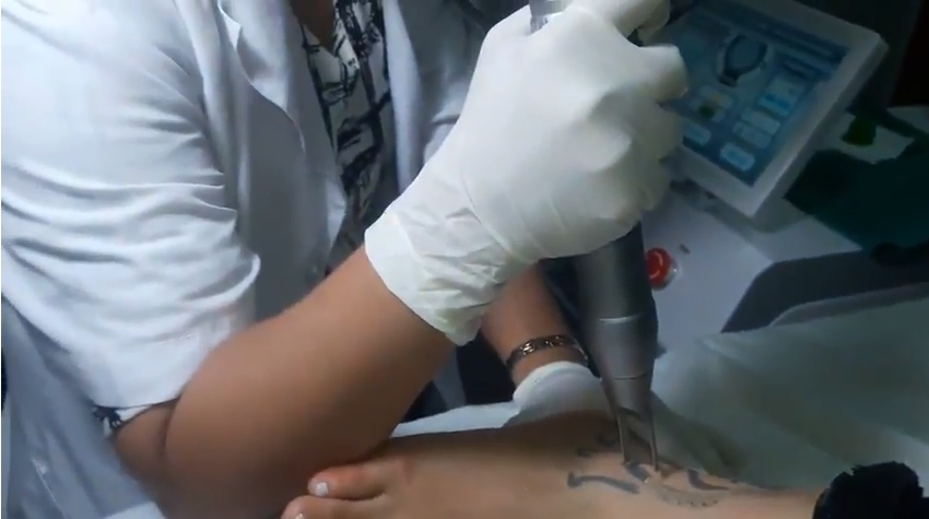 ruby laser q switch laser tattoo removal long pulsed nd yag laser