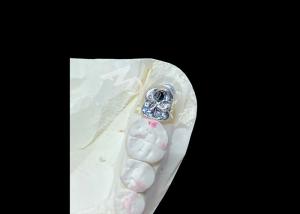 Wholesale Dental Implant Crown With Titanium Abutment And Porcelain-Fused-to-Metal PFM Crown from china suppliers