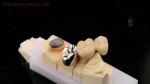 Vita Porcelian Full Metal Crown With Post Core 3 Years Guarantee from Dental Lab
