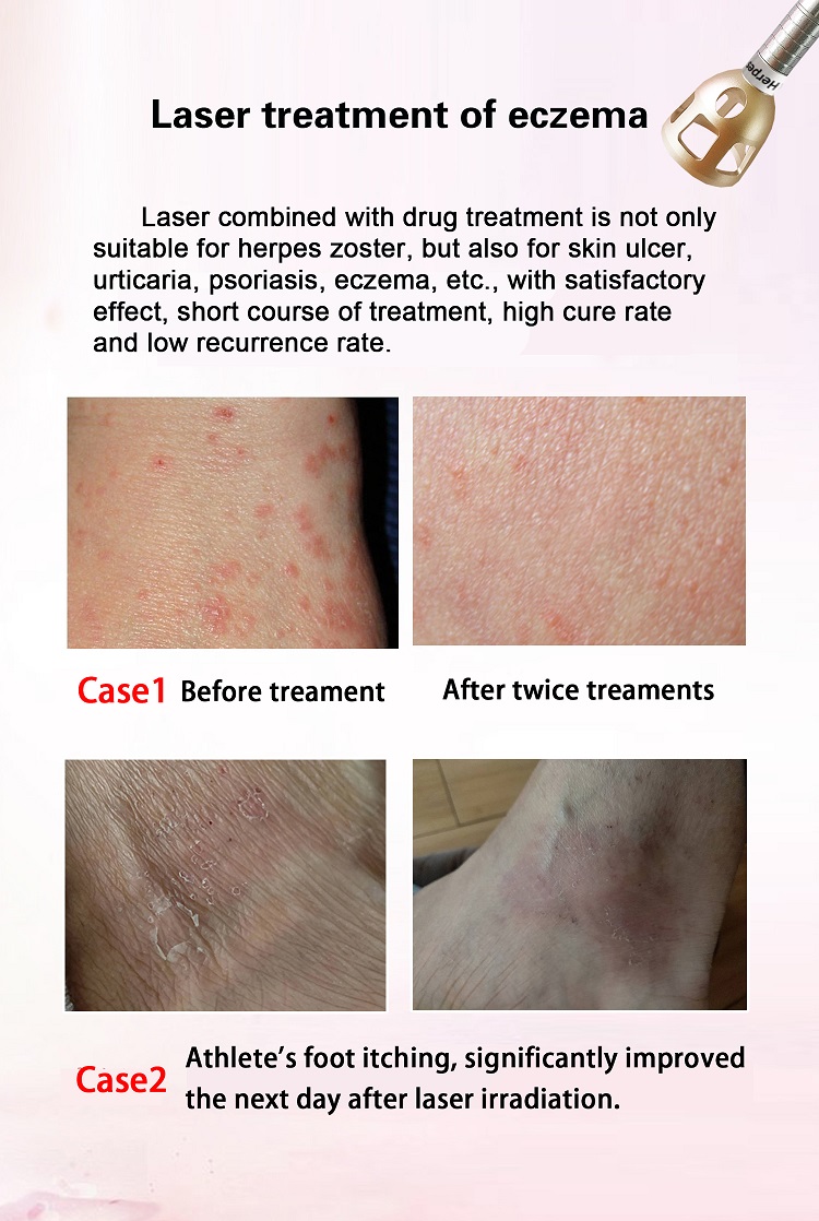 spider veins vascular vein removal nail fungus 980nm diode laser therapy machine for toe nail fungus treatment