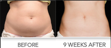 Body Slimming / Shaping Cryolipolysis Fat Freezing Machine With Intelligent Temperature Control