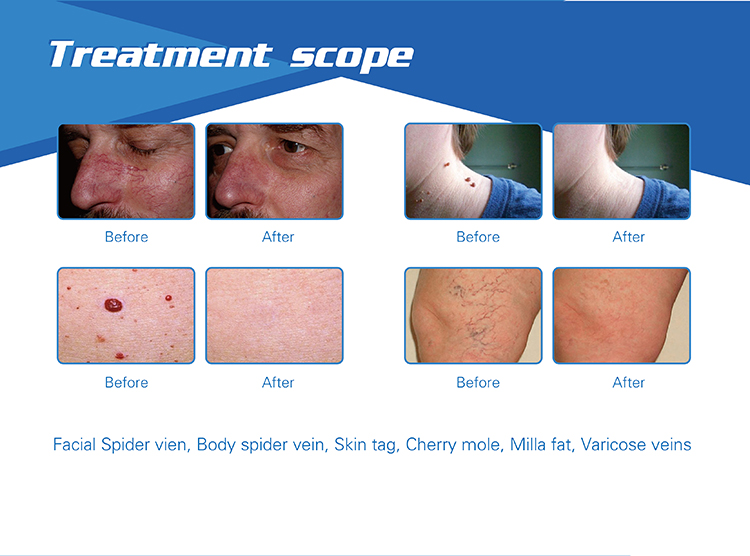 Latest laser vein removal 200W power germany imported diode laser device 980 nm laser vein removal machine for sale