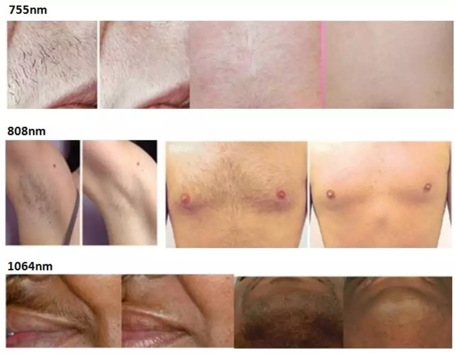 808nm / 755nm / 1064nm Diode Laser Hair Removal Machine Custom