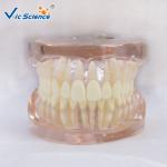 Peridontal Disease Teeth Study Model Human Dental Model Gingival Diseases