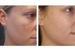 Skin Rejuvenation Water Diamond Microdermabrasion Machine