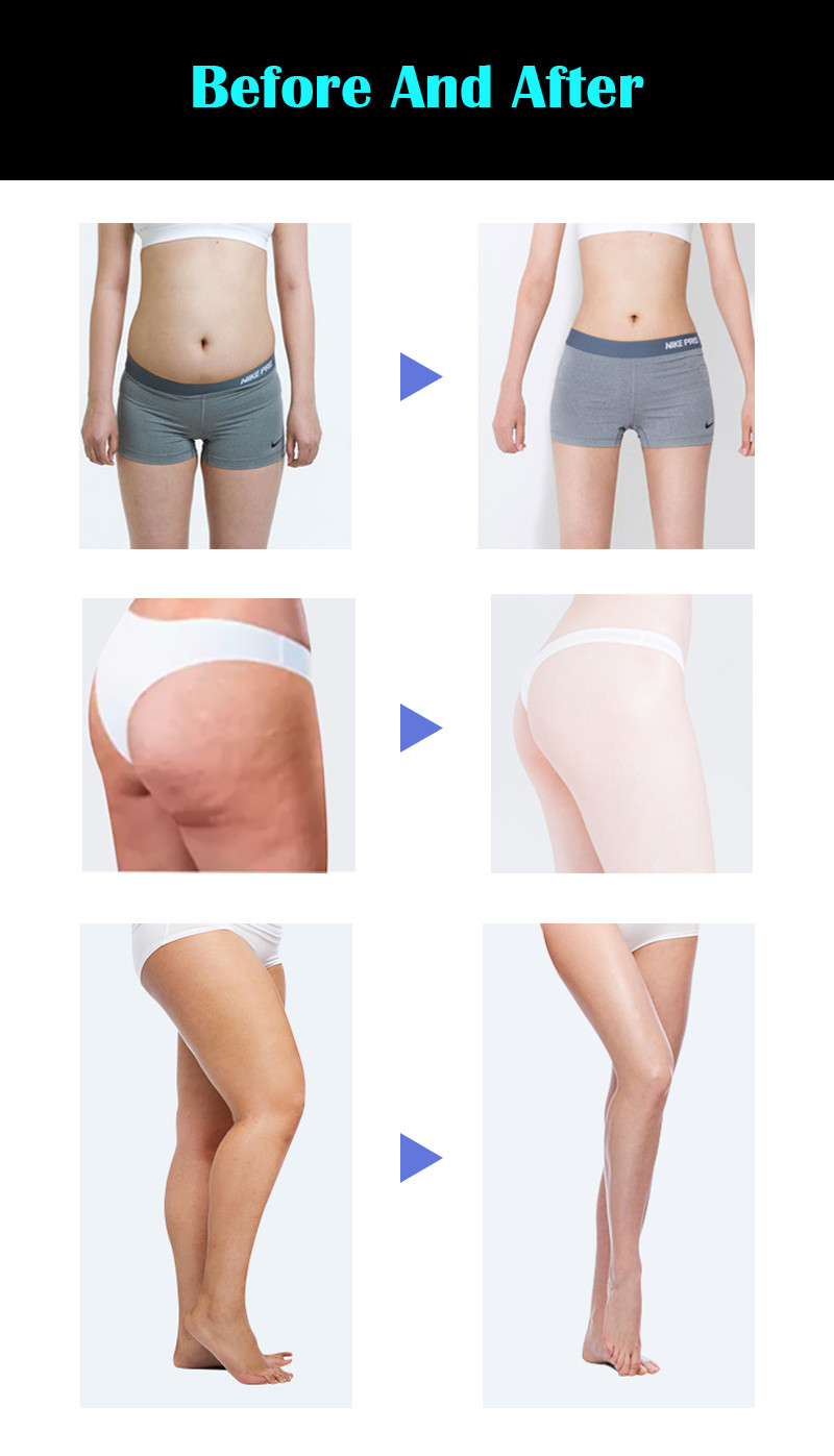 Body Sculpting Cryolipolysis Fat Freezing Machine