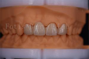 Wholesale FDA Certified Digital Crowns Bridge Dentrues Design Customizable Size from china suppliers
