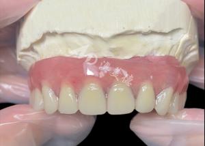 Wholesale Titanium implant supported Bar Attachment Dentures from china dental lab from china suppliers