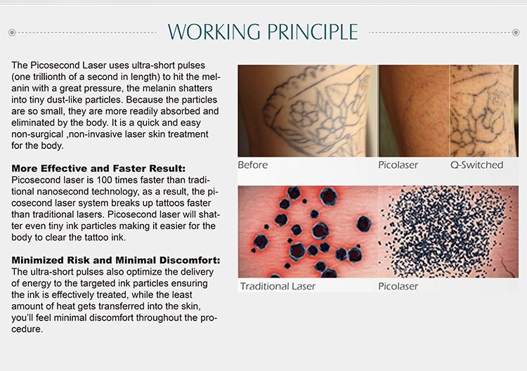 2019 new trending age spot freckle removal picosecond laser manufacturers