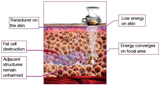 NEWS!!! Featured HIFUShape hifu slimming machine hifu ultherapy