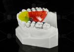 Stainless Steel Acrylic Screw Expander Orthodontic Treatment Removable