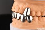 Dental Abrasive Resistant Crown Full Metal , Metallic FMC For Oral Rehabilitatio