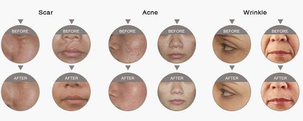 30w USA imported laser genarator White Color Co2 Fractional Laser Skin Rejuvenation Machine 10.4" Color Touch Screen