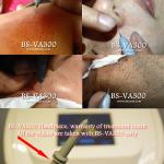 Non Invasive 30MHz Vascular Age Spot Removal Machine