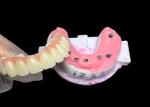 Wholesale Implant supported Full Arch Denture Fixed Dental implant Ceramic Crown Bridge from china suppliers