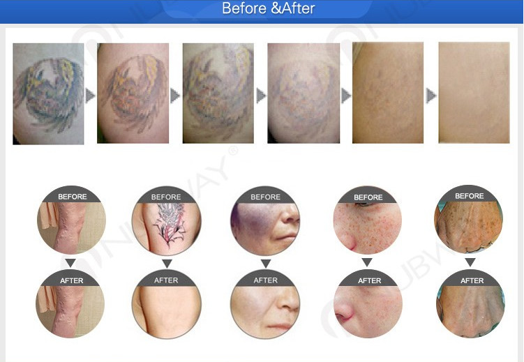 Q- switched nd yag laser tattoo removal Freckles pigment age spots removal beauty machine