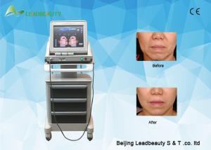 Wholesale High Intensity Focused Ultrasound face lifting wrinkle removal skin from china suppliers
