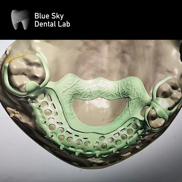 Lightweight Acrylic Resin Partial Denture With Metal Frame Realistic Looking Dentures