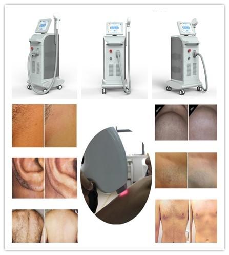 NUBWAY Diode laser hair removal/ 808nm Diode laser Depilation/ 808nm diode laser