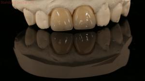 Wholesale Full Contour Zirconia Crown and High Aesthetic Natural Dental Bridge 5 Year Guarantee from china suppliers