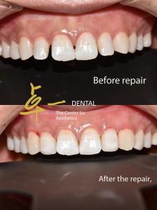 Wholesale Say Hello To A Flawless Smile With Cosmetic Dental Veneers No Discoloration No Preparation from china suppliers