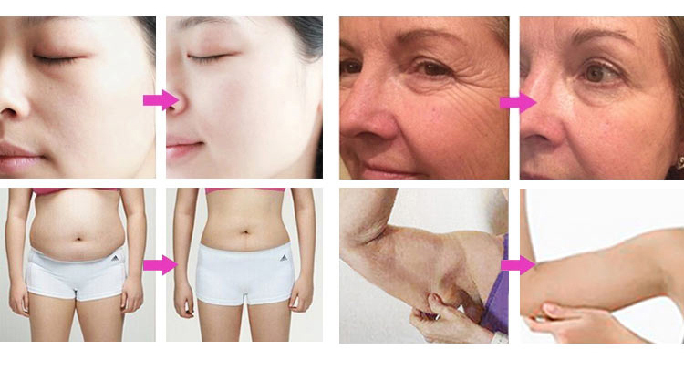 Portable Radio Frequency Machine Rf Body Massage Eyes Face Wrinkle Free Device