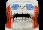Frankel 2/3 Orthodontic Appliance, enhancing Jaw Alignment in Growing Children