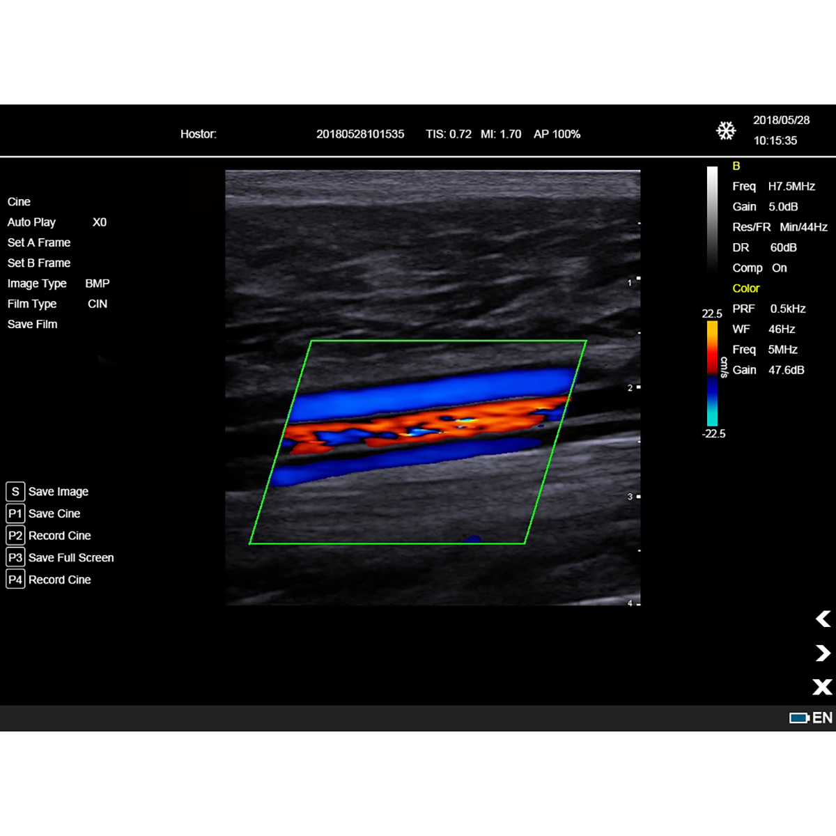 Color Doppler Portable Ultrasound Machine Medical USG PW CW DICOM Cardiac Probe Cardiology for Hospital Clinic