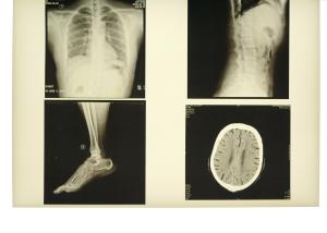Wholesale 13in x 17in Degradable X Ray Diagnostic Imaging Medical Paper For Laser Printer from china suppliers