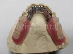 Wholesale OEM Flexible Removable Partial Denture Easy To Clean / Maintain from china suppliers