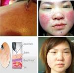 Spider Vein Treatment unit Cost