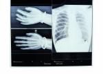 10 x 14inch Dry Medical X Ray Films For Fuji 3000 / 2000 / 1000