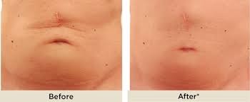 Advanced Diode Laser Lipolysis Machine For Targeted Fat Reduction In Abdomen To Arms 30-60 Min Treatment Time