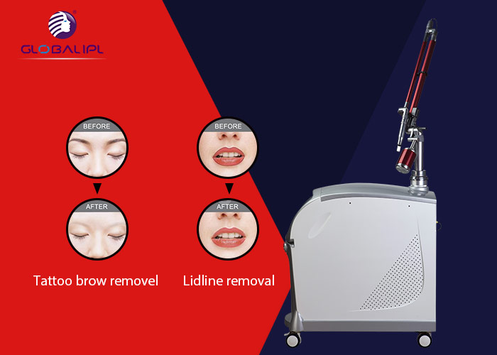laser for tattoo removal17.png