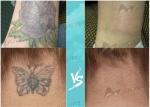 Best High Energy 1500mj 1064nm 532nm Painless Permanent Skin Age Spot Freckle