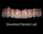 Titanium Full Zirconia Bridge Dental Translucency On Implant Bar