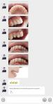 Anterior Tooth Indication Dental Veneers With 0.5mm Thickness And Perfect