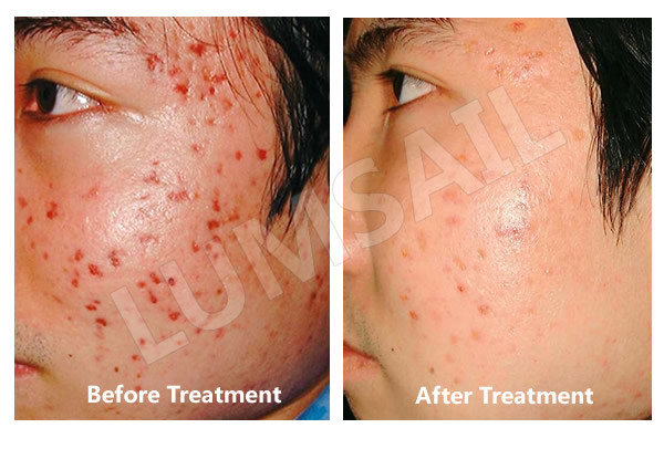 4 ColorLED Phototherapy Machine For Decrease Spider Veins / Broken Capillaries