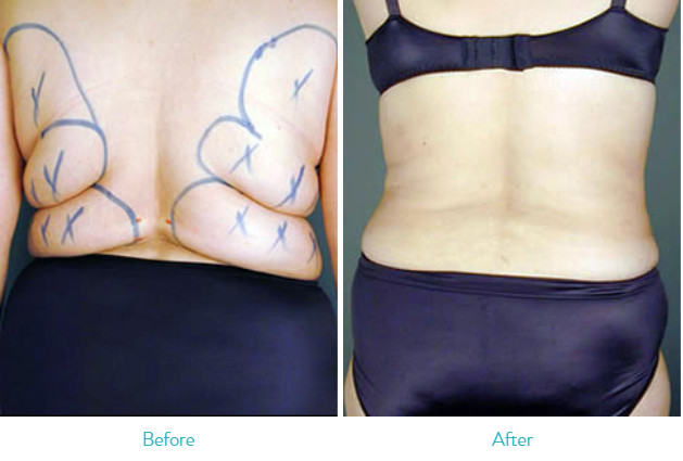 Ultrasonic Power Assisted Liposuction Equipment Adjustable Vacuum Range