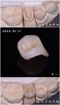 Accurate Fit Dental Porcelain Inlay Damaged Teeth Restoration For Adults And