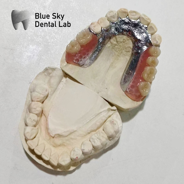 Dental Cast Partial Denture Framework Partial Dentures That Look Real
