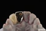 Metallic Dental Maryland Bridge Good Chewing Function For Long Lasting