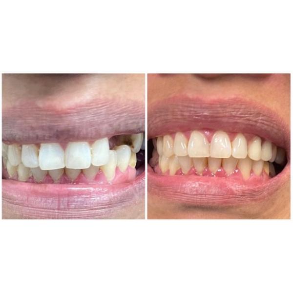 SHT Ultra Ceramic Zirconia Blocks Dental 900 MPa High Flexural Strength