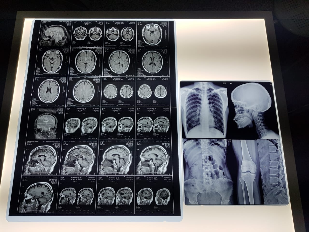 Waterproof 215 Micron PET Based Medical X Ray Film