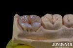 Natural Color Accurate Fit Dental Inlay For Damaged Teeth Restoration