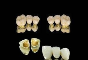 Wholesale High Nobel Yellow Gold Crown Be Nickel Free PFM Tooth Crown from china suppliers