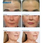 muscle focused for face antiage EMS Muscle Stimulator For Face Lifting Neck